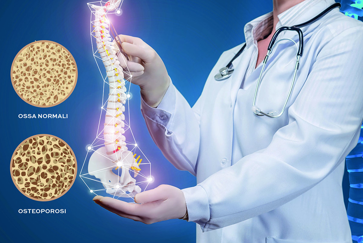 Osteoporosi - differenza tra ossa sane e ossa con osteoporosi