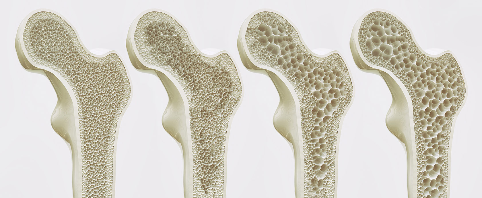 Osteoporosi e MOC - gli stadi degenerativi dell'osteoporosi 