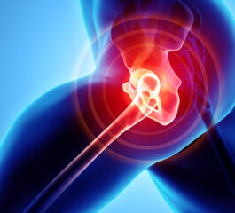 Artrosi dell’anca: cause, limitazioni funzionali e cure più indicate