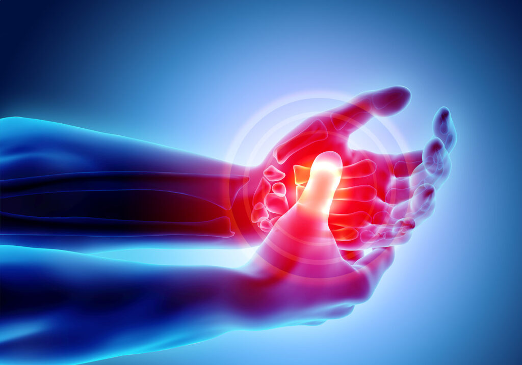 artrite alla mano - capire le cause