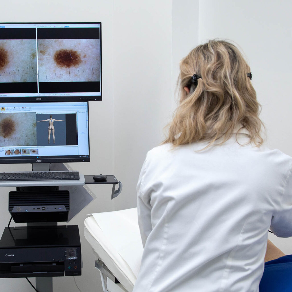 Melanoma e raggi UV: perché l’estate è il momento giusto per il controllo dei nei